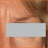 Botox
