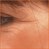 Botox
